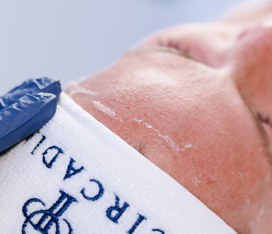 Hautschuppen beim Dermaplaning