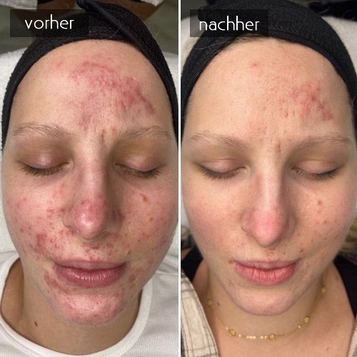 Oxygen Rx Behandlung bei Akne Vorher-Nachher Bild einer Oxygen Rx Behandlung bei Akne