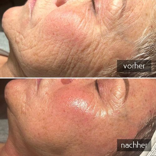 Swich Behandlung bei Falten Vorher-Nachher Bild einer Swich Behandlung bei Falten