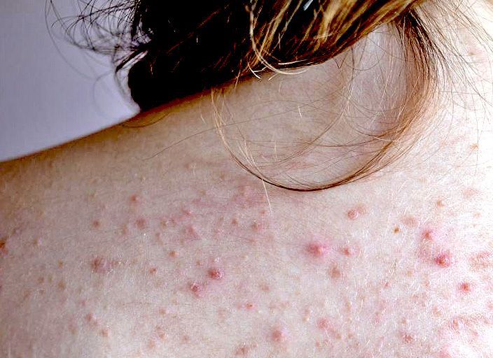 Großaufnahme von einem Rücken mit Akne