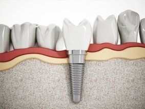 Implantate Zahnarztpraxis Dres. Birgit und Bertram Winkler Implantate Zahnarztpraxis Dres. Birgit und Bertram Winkler