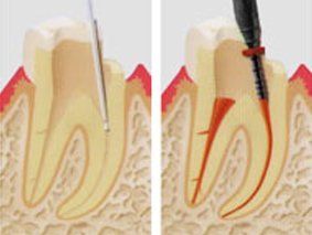 Endodontie Zahnarztpraxis Dres. Birgit und Bertram Winkler Endodontie Zahnarztpraxis Dres. Birgit und Bertram Winkler