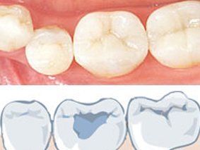 Konservierende Zahnheilkunde Zahnarztpraxis Dres. Birgit und Bertram Winkler Konservierende Zahnheilkunde Zahnarztpraxis Dres. Birgit und Bertram Winkler