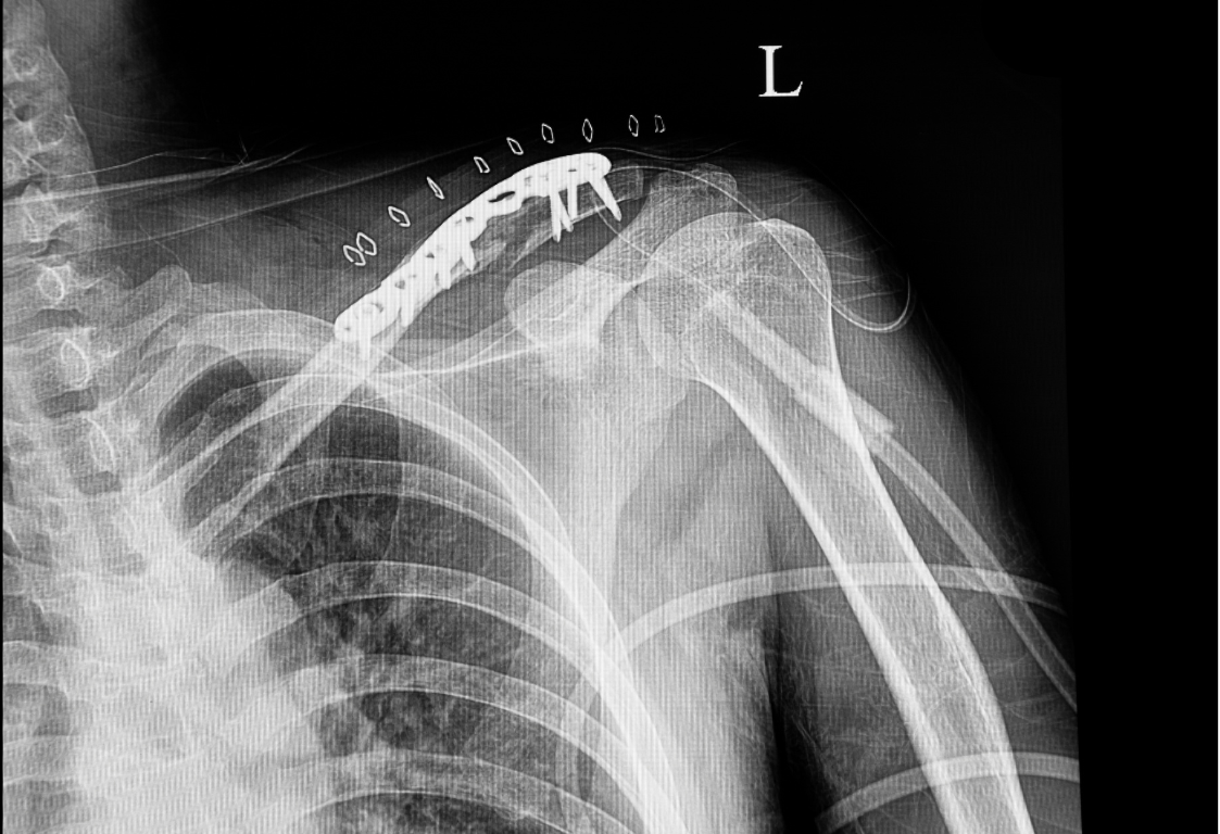 Gearing Up for Shoulder Surgery Recovery