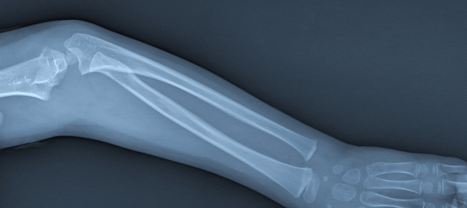 Broken Arm Xray