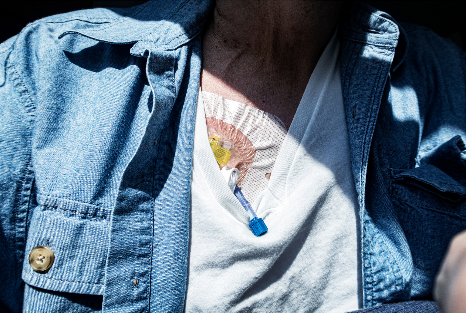Man having dialysis through a chest port wearing a tshirt