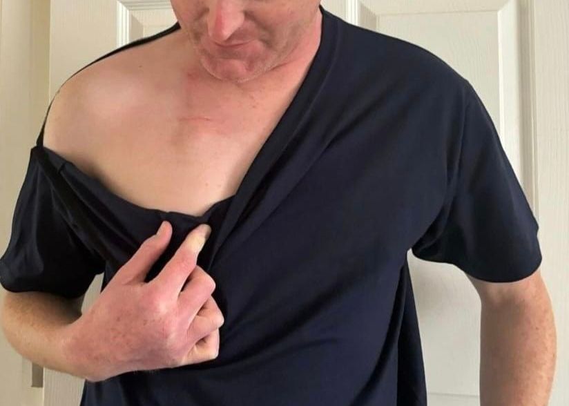 Shoulder opening chemo tshirt Image shows a man wearing a shoulder opening velcro tshirt, partially open to show where he accesses his port line for chemotherapy