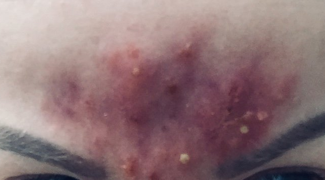 Hautpilz im Gesicht und falsche Pflege Hautpilz, dermatologische Kosmetik, Ekzem, Haukrankheit