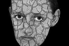 So muss es nicht aussehen Neurodermitis
