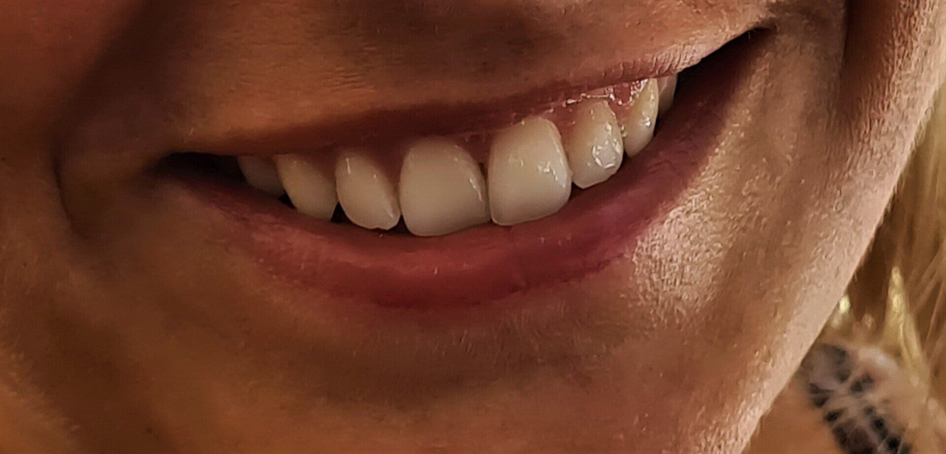 Lächeln mit Zahnimplantat