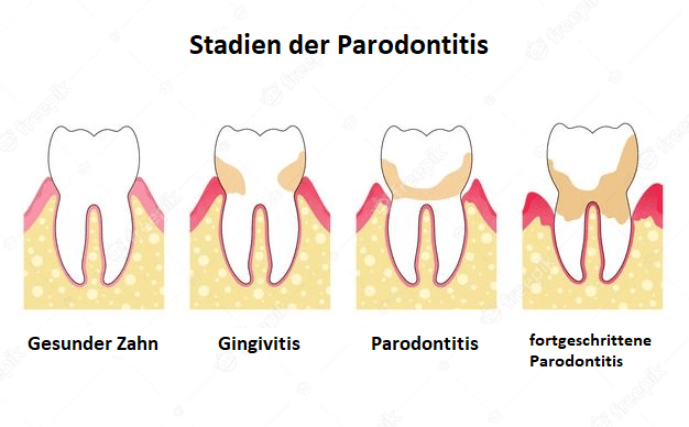 Zahnarztpraxis Troisdorf Parodontitis