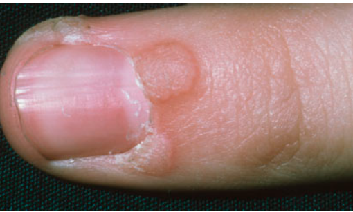 Wart Removal training for your Clinic, Salon or Pharmacy