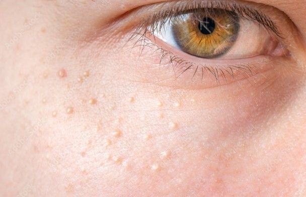 Skin tags, milia, skin lesions removal training course