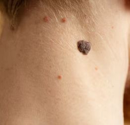 Lesion Removal with Diathermy