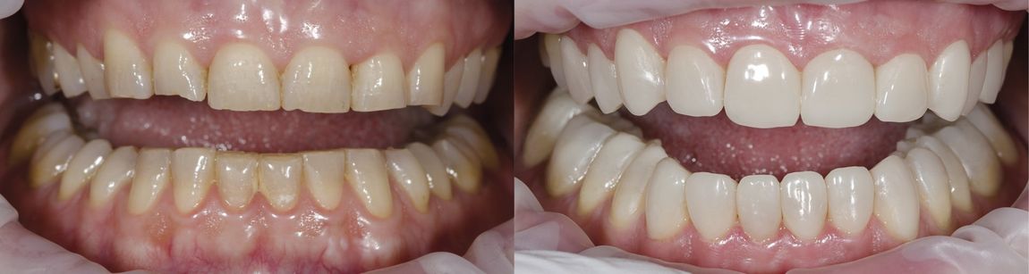 before & after smiles with edelweiss VENEERs