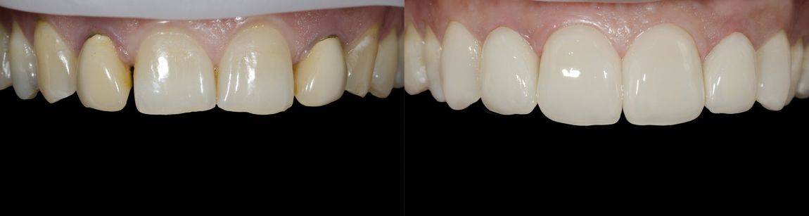 before & after smiles with edelweiss VENEERs