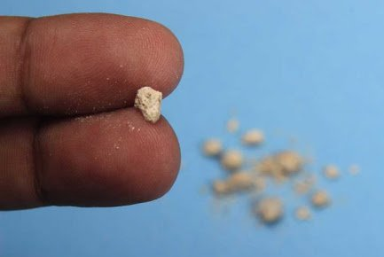 L'acqua contro i primi sintomi dei calcoli renali