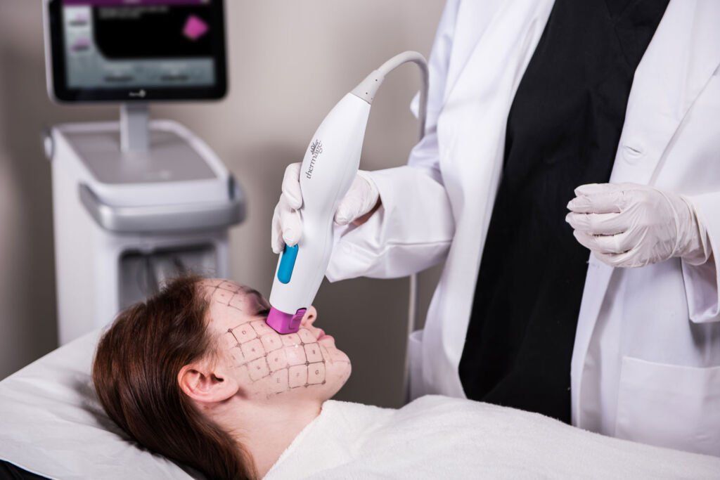 Thermage FLX RF Skin Tightening and Contouring for lifting, firming, and tightening