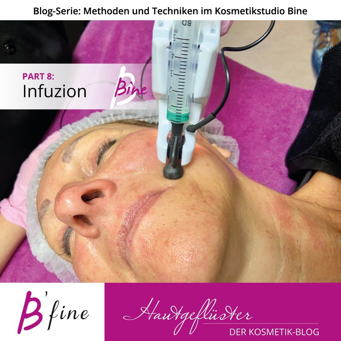 Haut Volumenaufbau und Faltenglättung Infuzion, die Sache mit dem