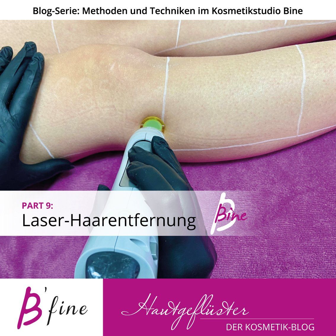 Laser-Haarentfernung Dauerhafte Haarentfernung mit Laser
