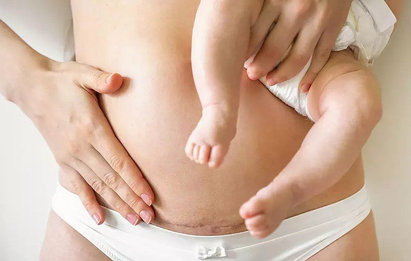 Bauch mit Kaiserschnittnarbe