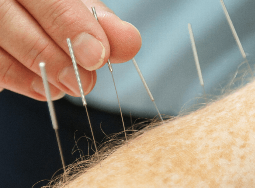 Acupuncture