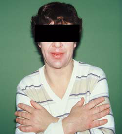 Akromegalie-Patient Patient mit Akromegalie