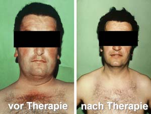 Patient mit Cushing-Syndrom Patient mit Cushing-Syndrom