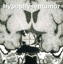 Hypophysentumor Hypophysentumor - Geschwulst der Hirnanhangsdrüse