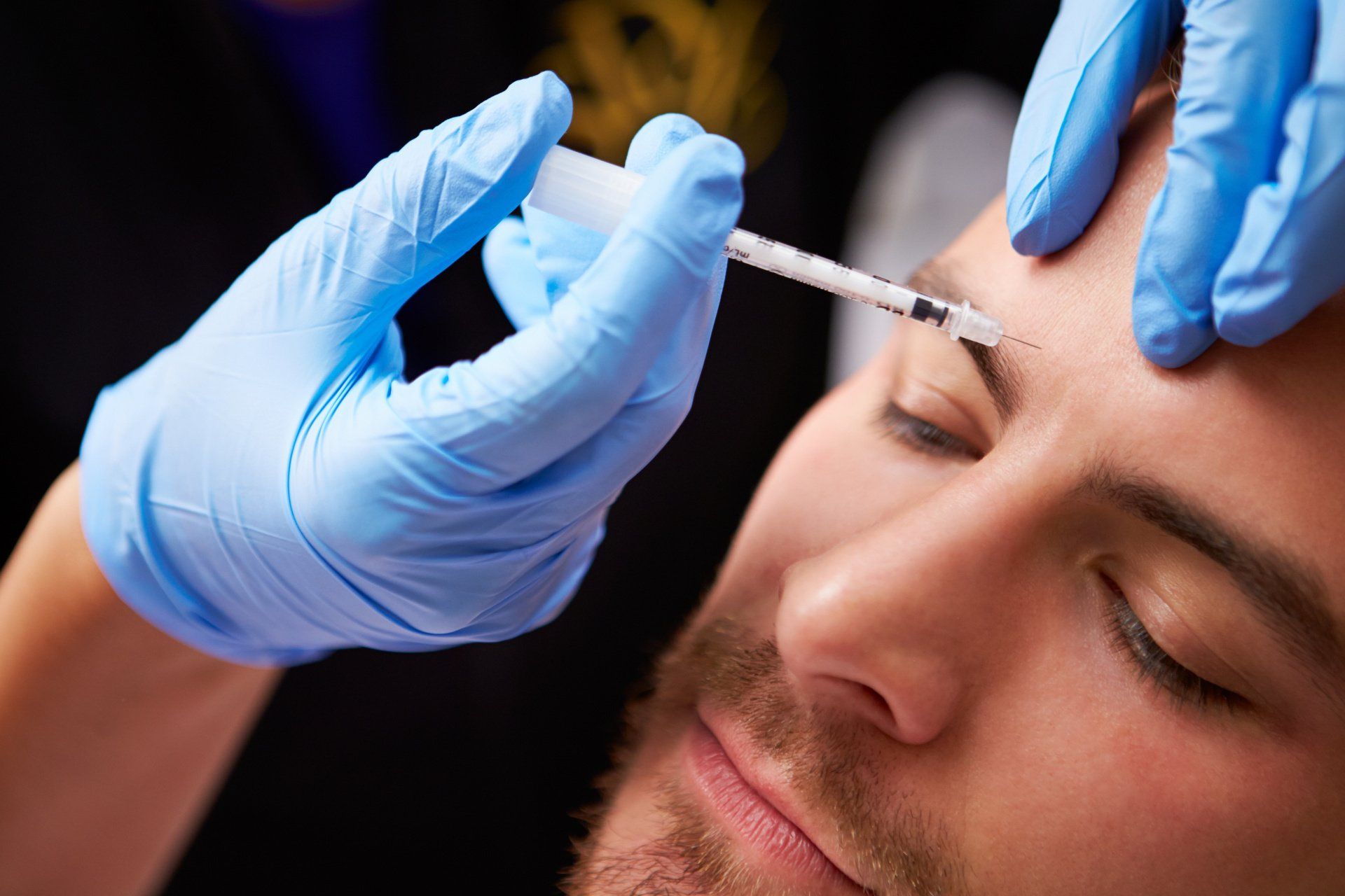 Botox zur Therapie der Zornesfalte bei einem Mann