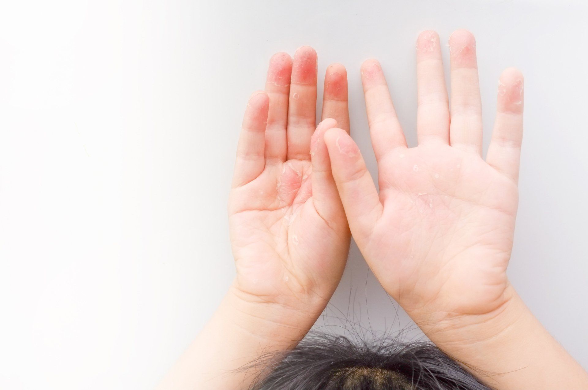 Hand-Fuß-Mund-Krankheit - eine hochansteckende Viruserkrankung welche nicht nur Kinder betrifft.