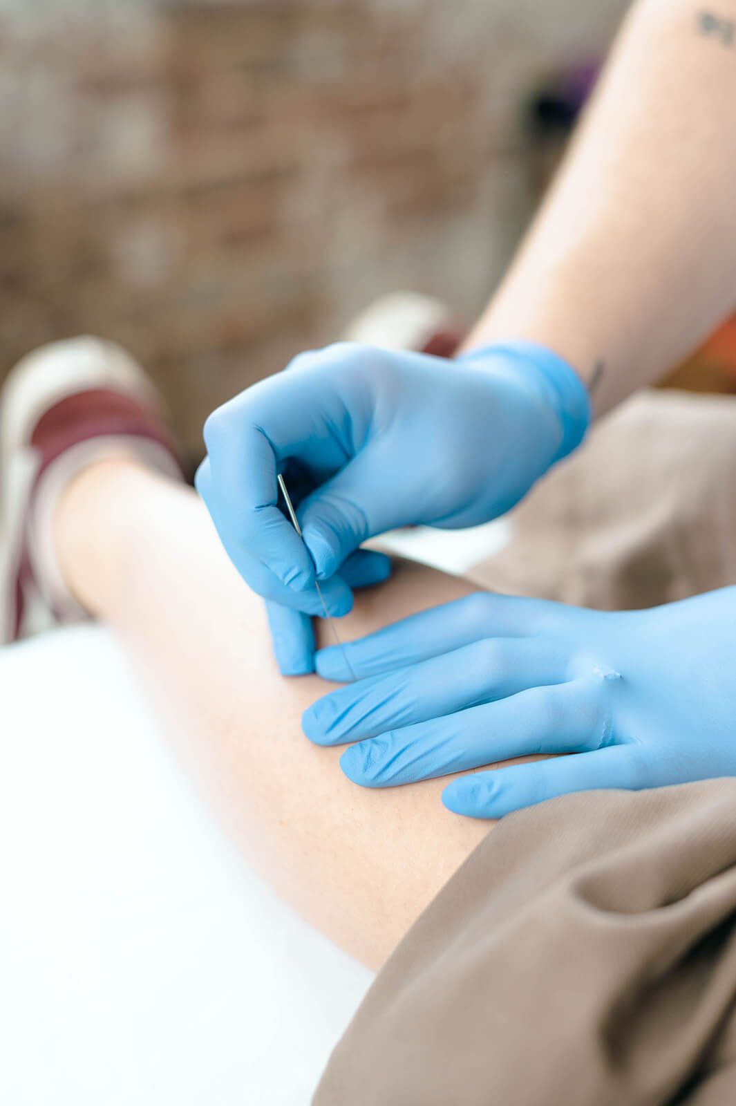 Dry Needling Dry needling physical therapy Baltimore Maryland