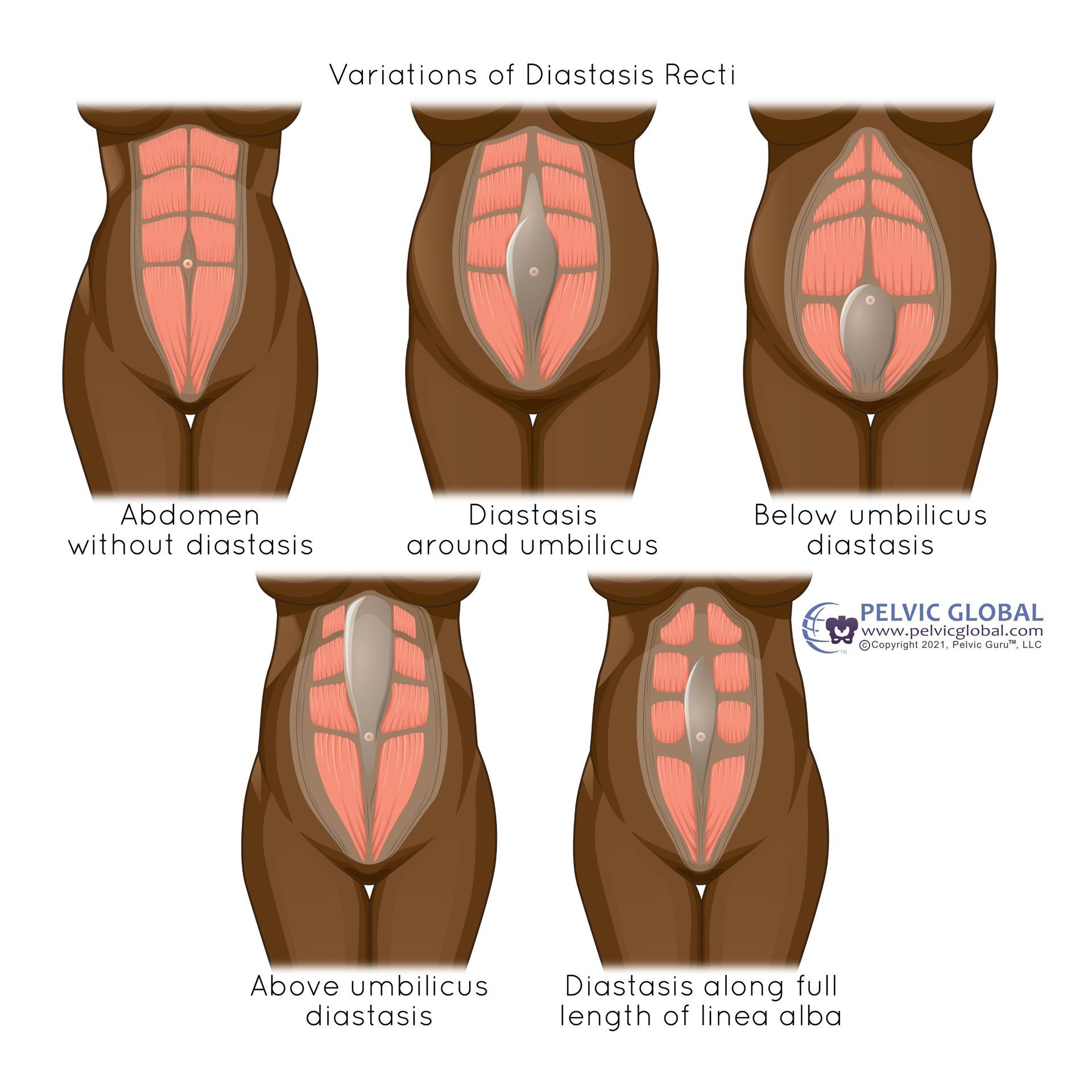diastasis recti abdominal separation in pregnancy
