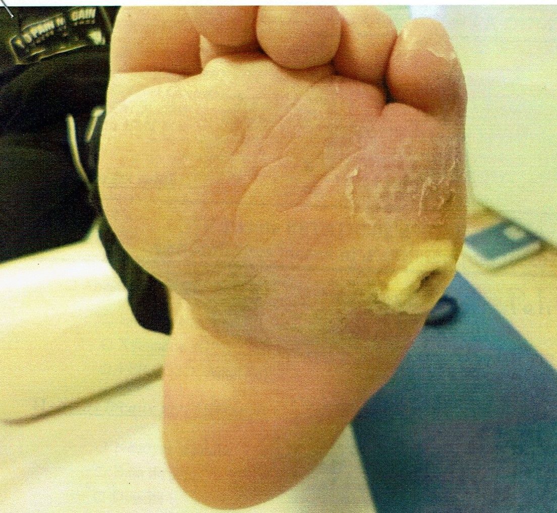 Mal perforant plantaire et ostéite