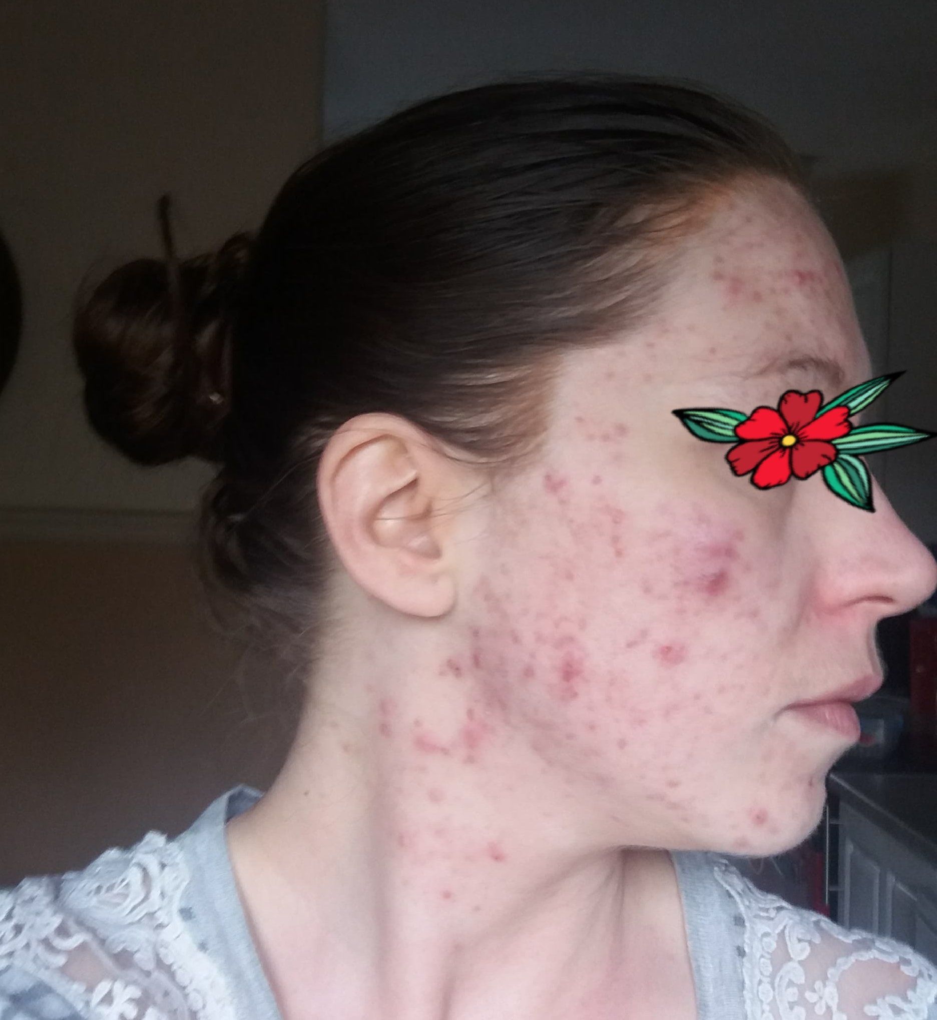 6th Dec 2018 right side of face