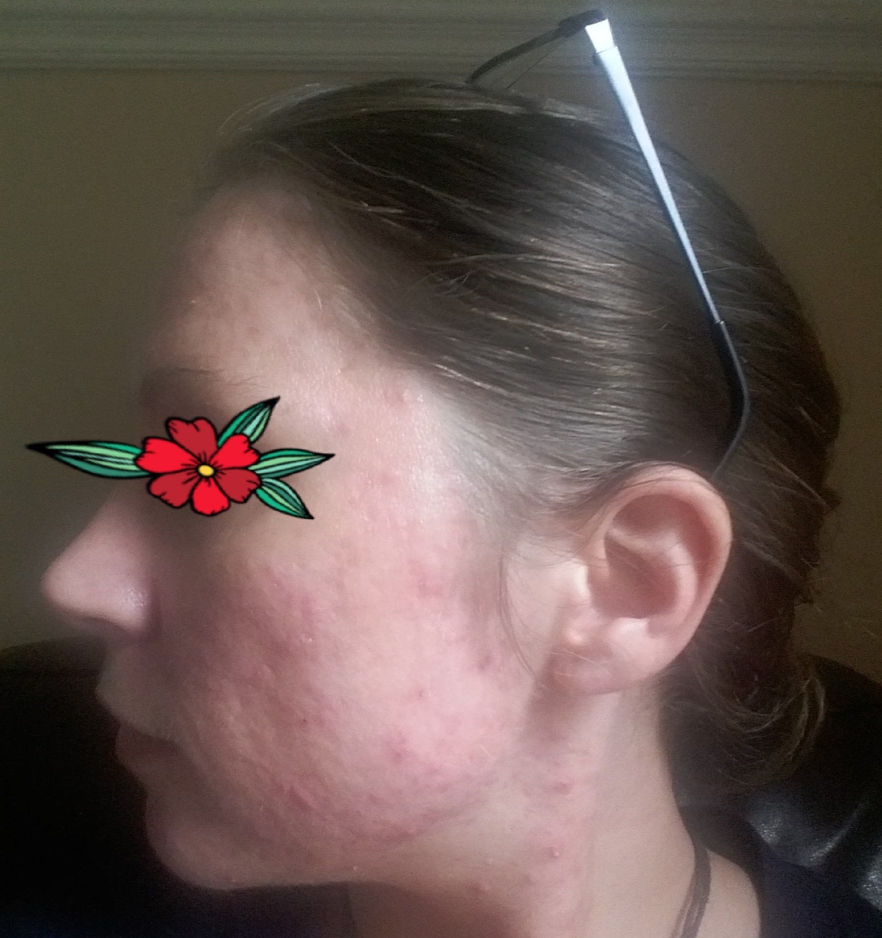 lest side of face