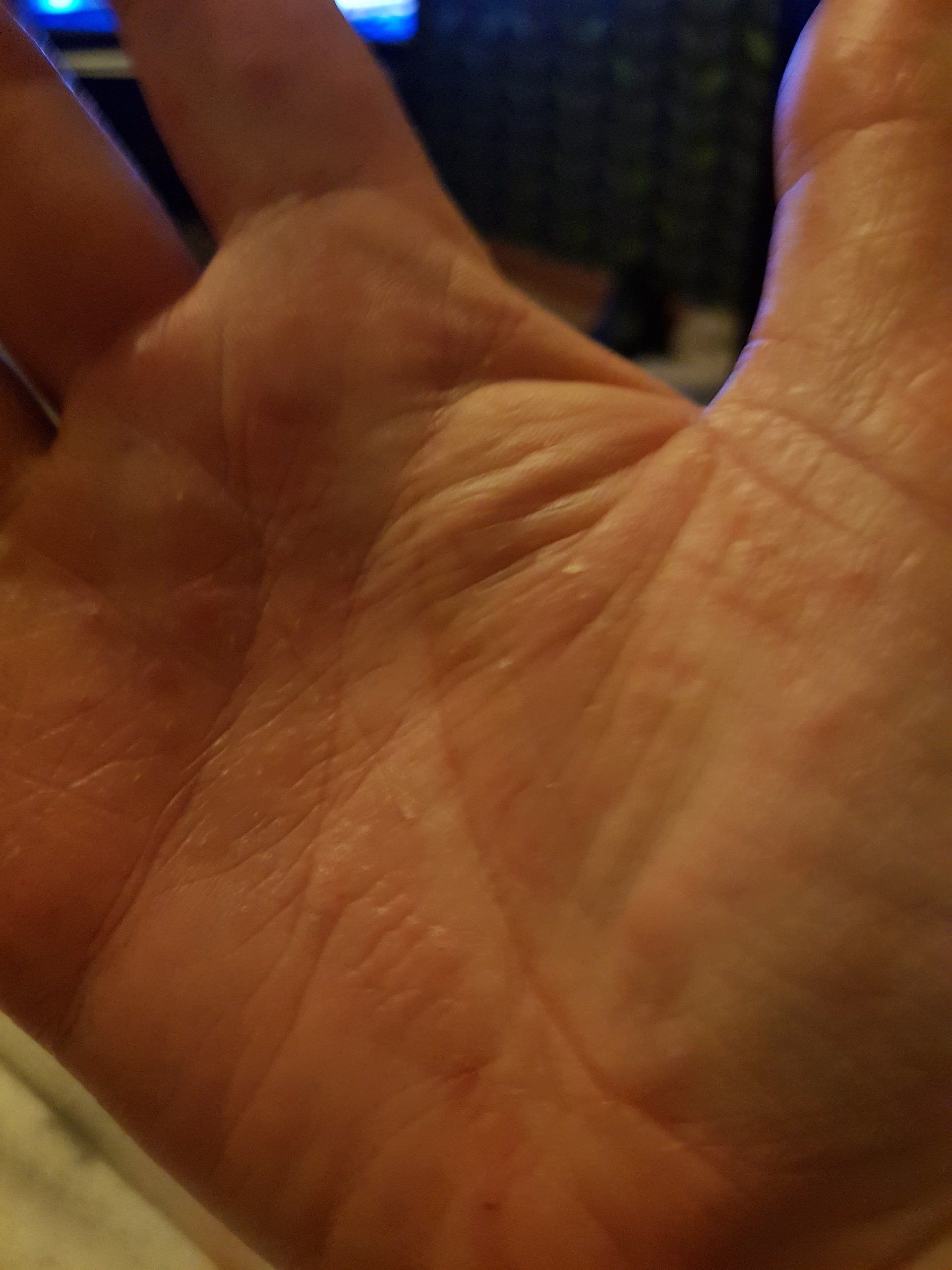 open palm right hand showing improvement