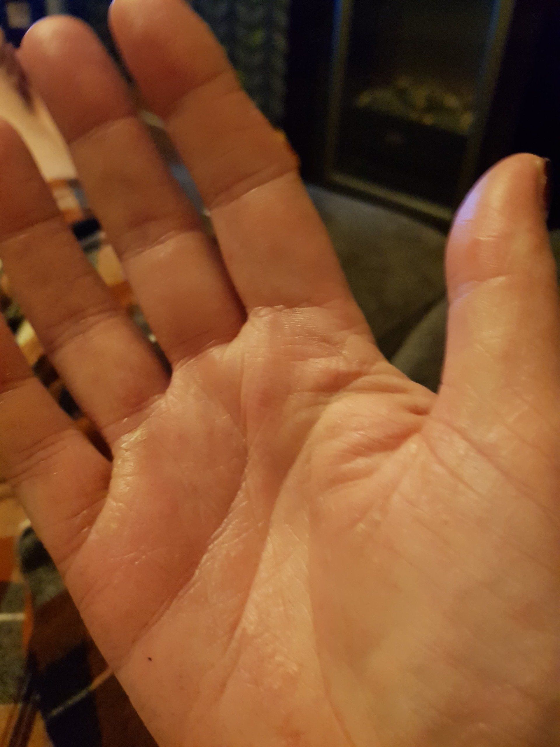 open right hand showing hand is now healed