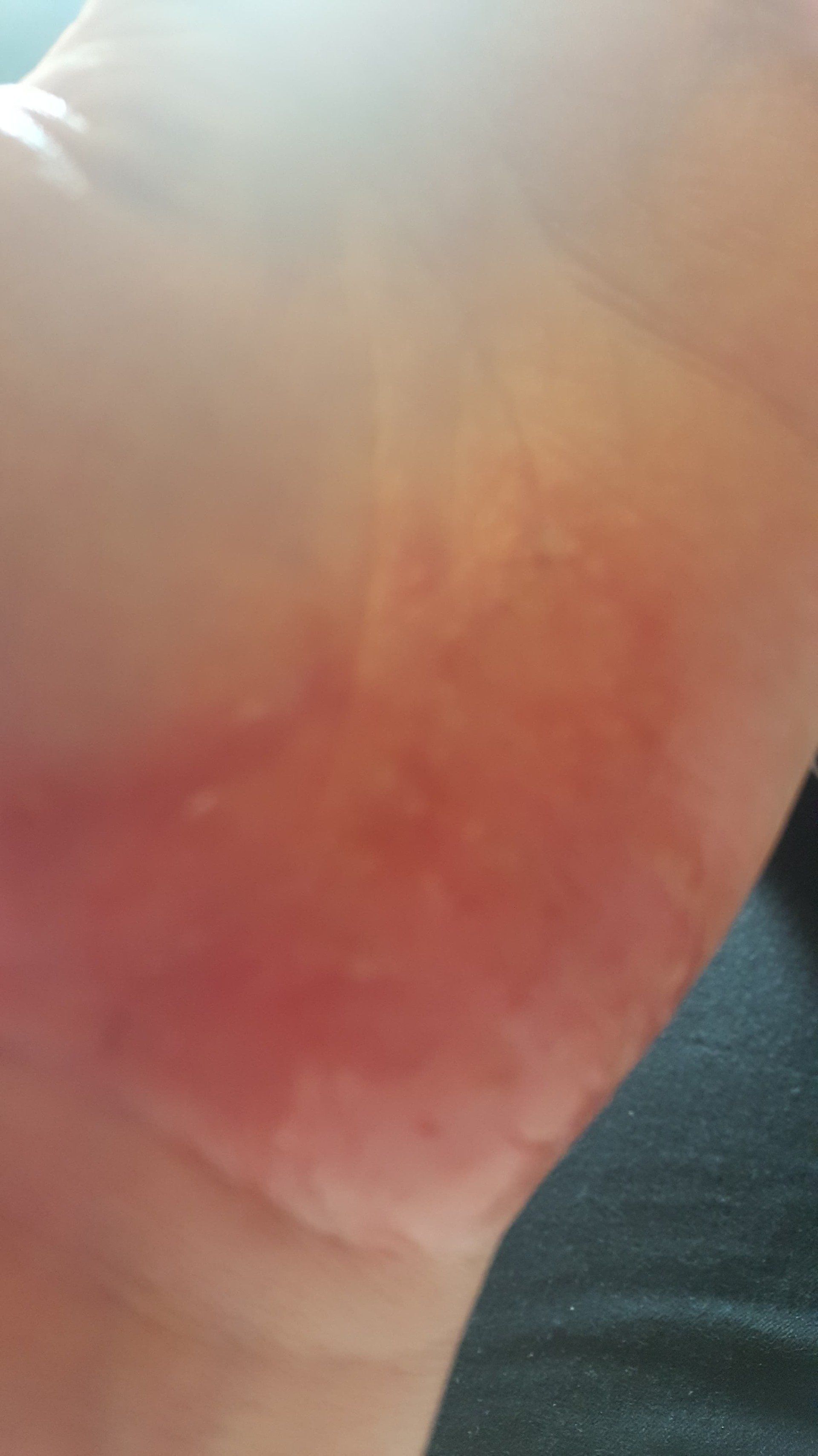 Day 1 different view of hand