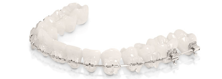 ortodoncia estetica noja