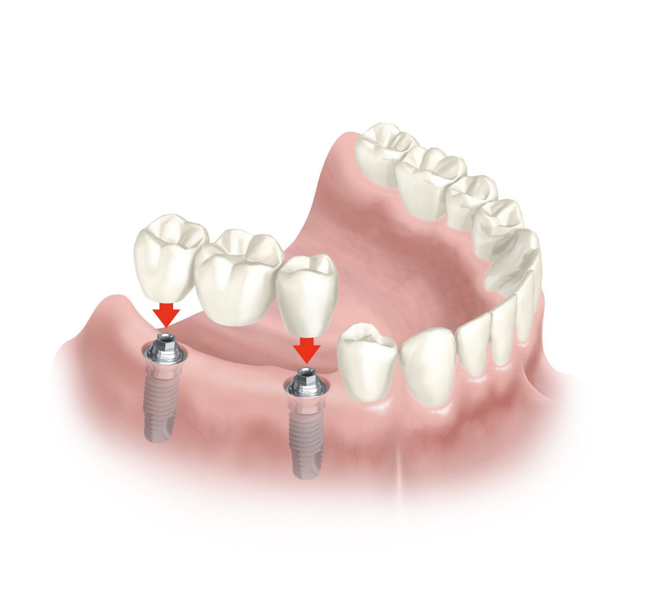 puente sobre implantes