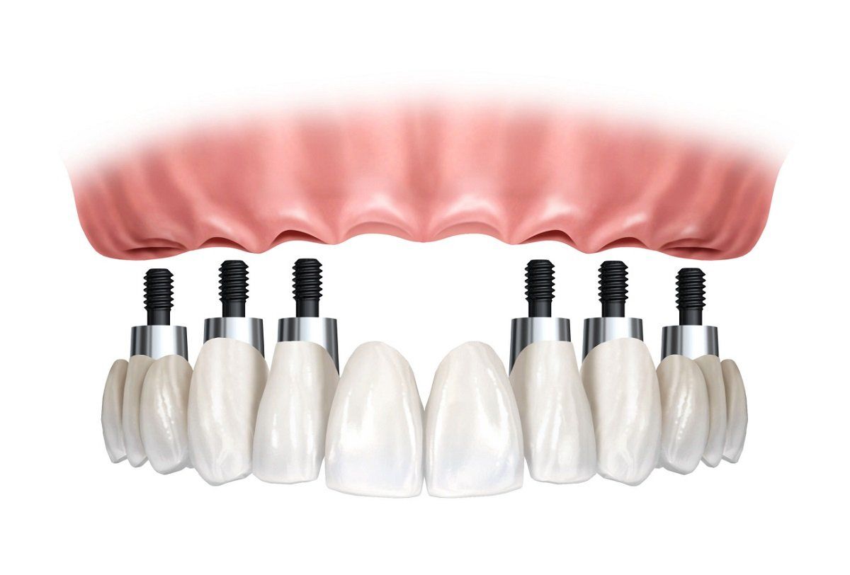 protesis fija sobre implantes