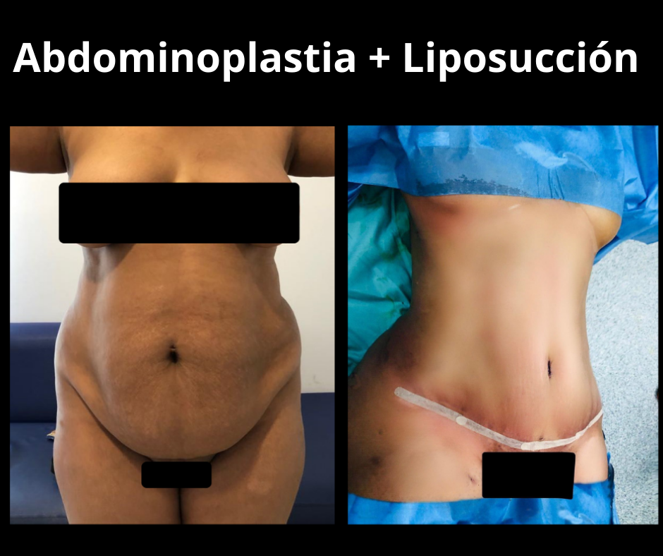 Abdominoplastia y Liposucción