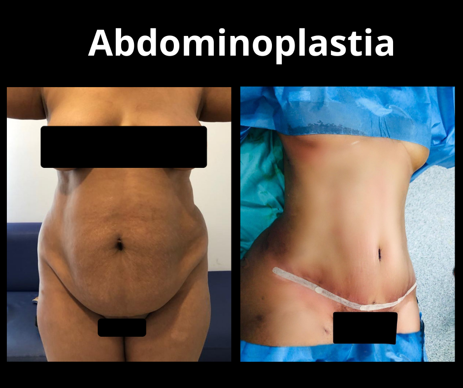 Abdominoplastia