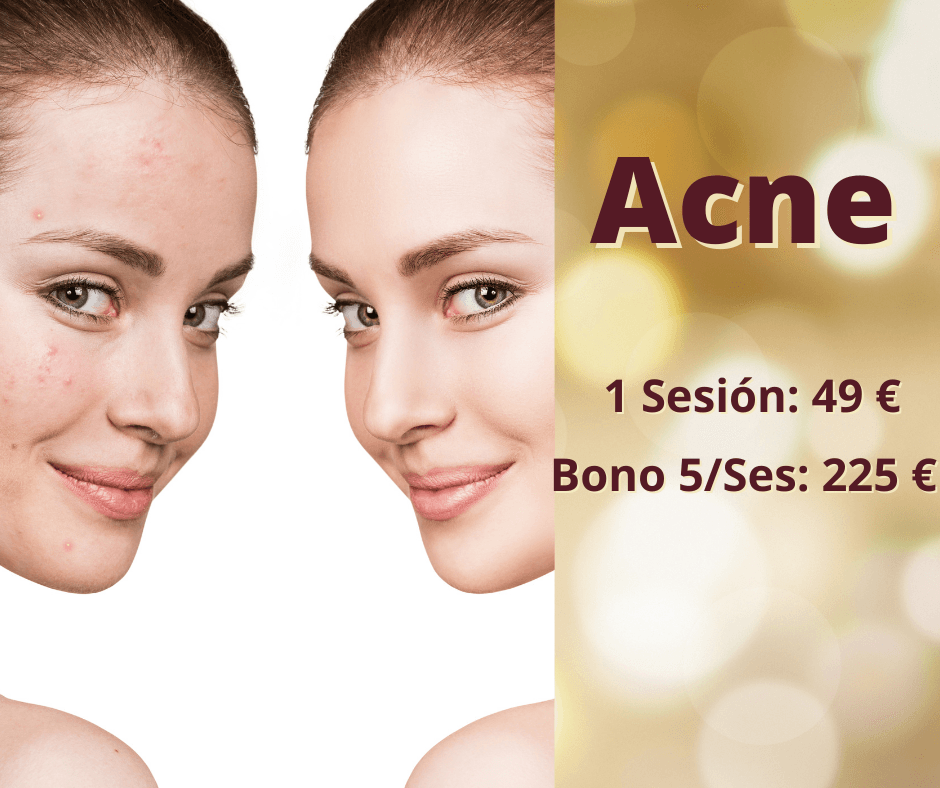 Combatir el acne