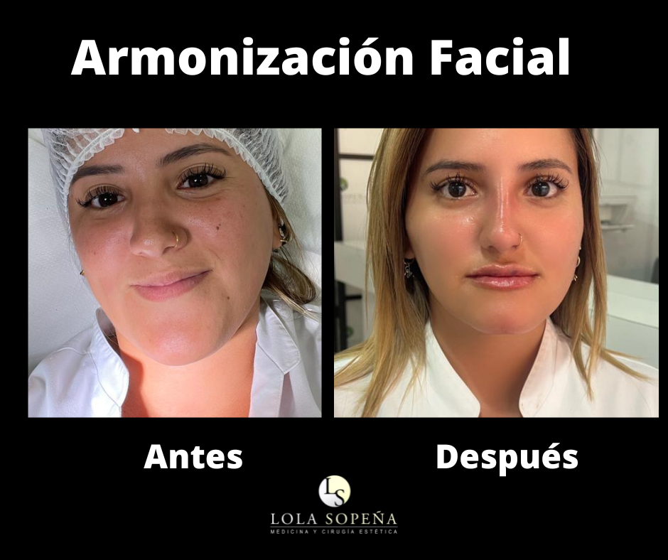 ARMONIZACION FACIAL