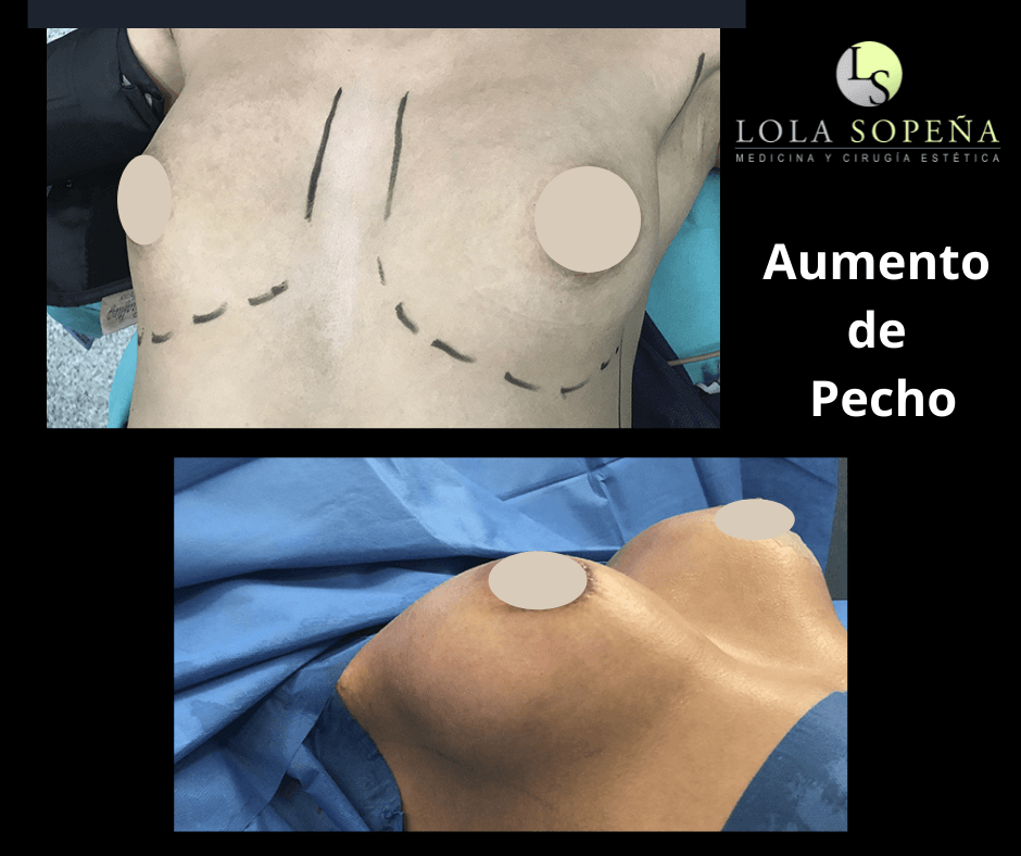 Aumento de Pecho