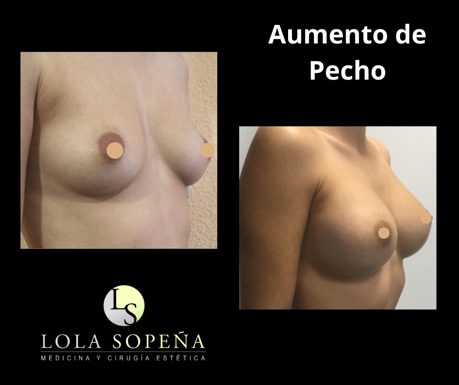 Aumento de Pecho