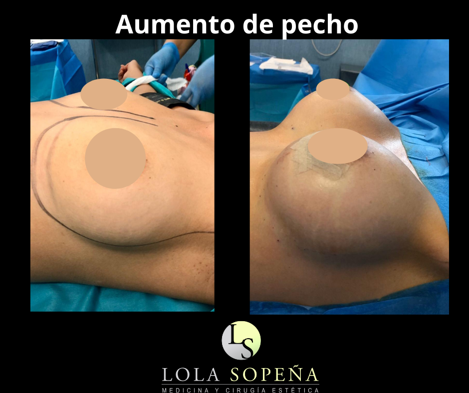 Aumento de Pecho