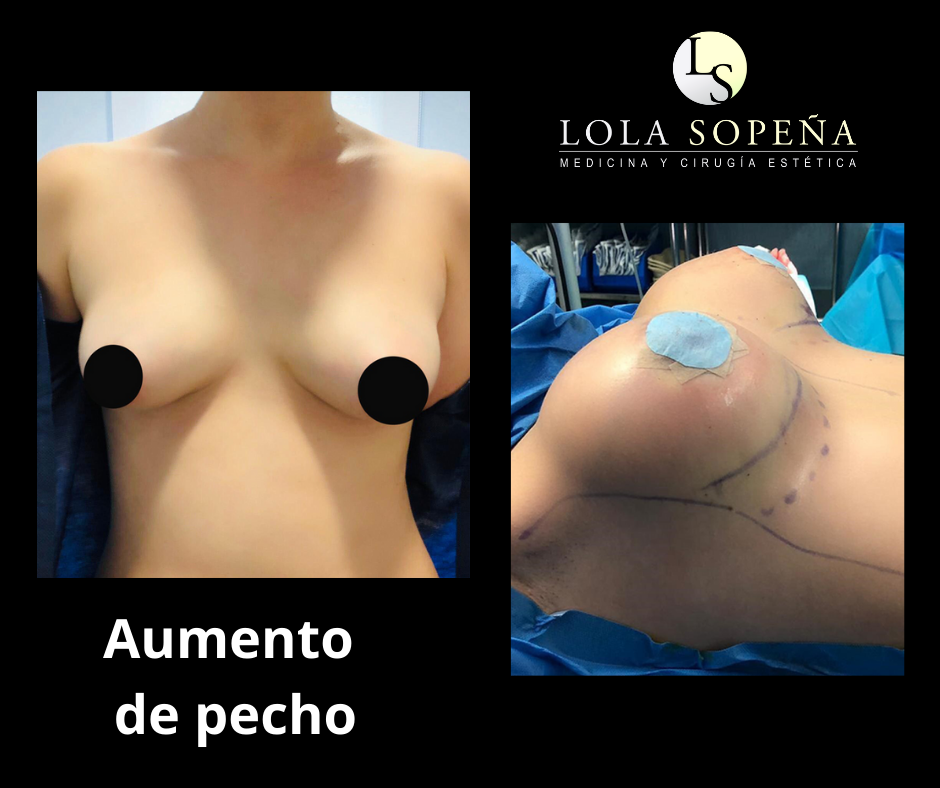 Aumento de pecho